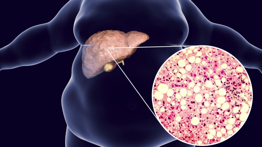 What is Fatty Liver? Symptoms, Causes, Treatment