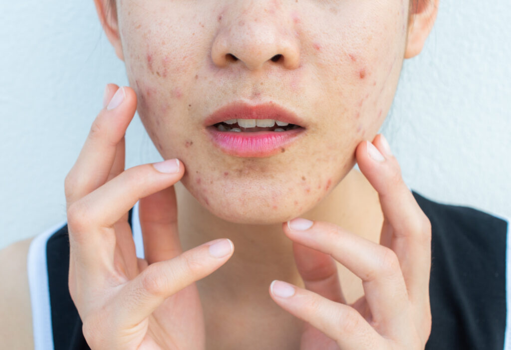What is Acne? Symptoms, Causes, Diagnosis, Treatment