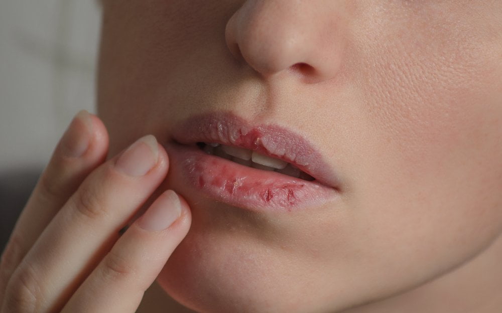 Causes and Treatment of Skin Peeling on the Lip